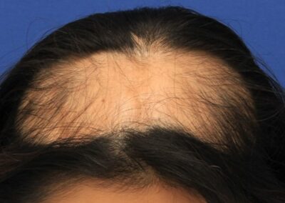 女性の瘢痕性脱毛の程度が評価され、患者の植毛手術への準備が整います。