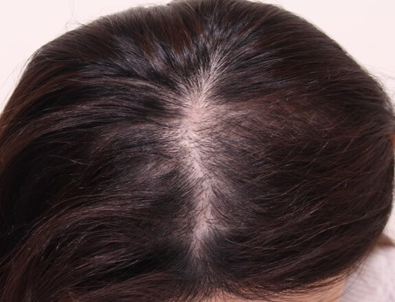 植毛手術後、患者の髪は完全に自然に見え、患者は満足しています。