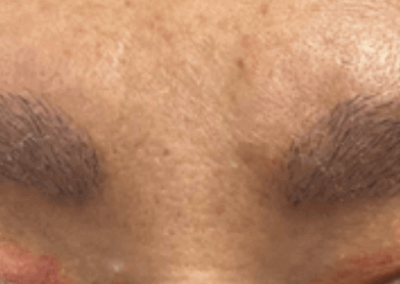 眉毛移植手術後、新しい眉毛は完全に自然に見え、患者は満足しています。
