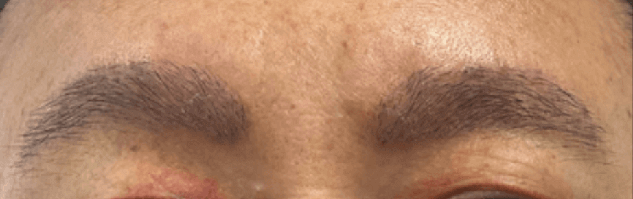 眉毛移植手術後、新しい眉毛は完全に自然に見え、患者は満足しています。