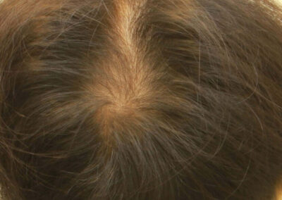 頭頂部の脱毛の程度が評価され、患者は植毛手術の準備ができています