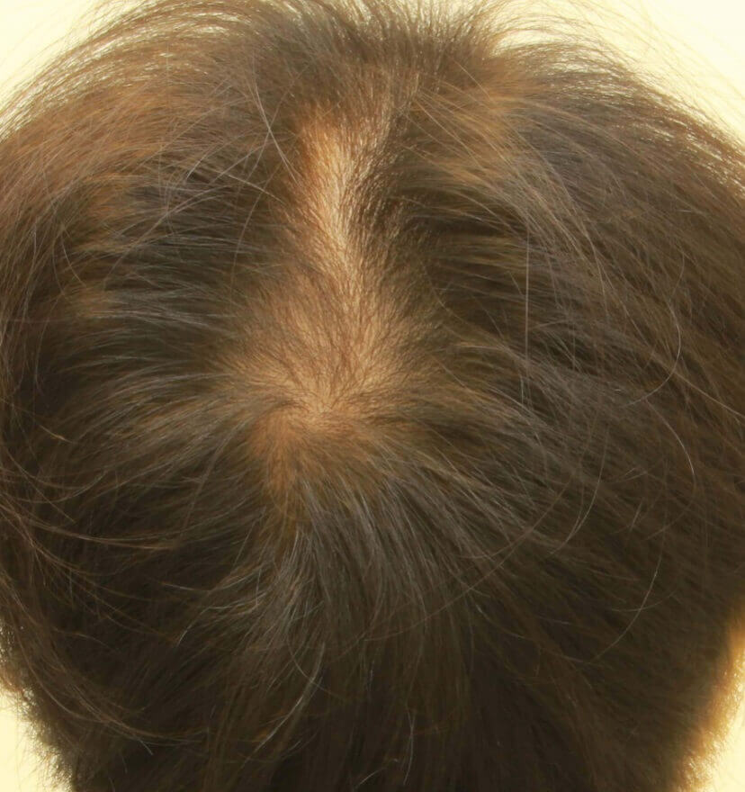 頭頂部の脱毛の程度が評価され、患者は植毛手術の準備ができています