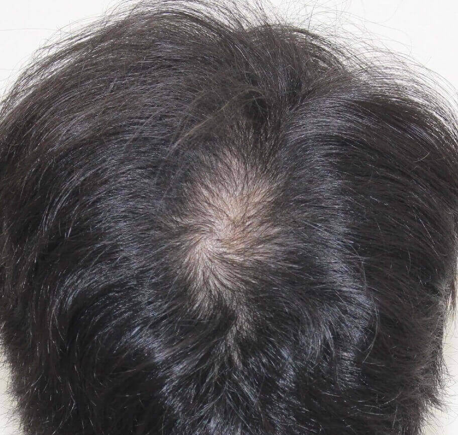 植毛手術後、患者の頭頂部の毛は完全に自然に見え、患者は満足しています。